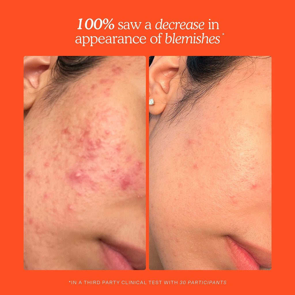 SOS Daily Hypochlorous Acid Spray for Breakouts & Redness-Tower 28