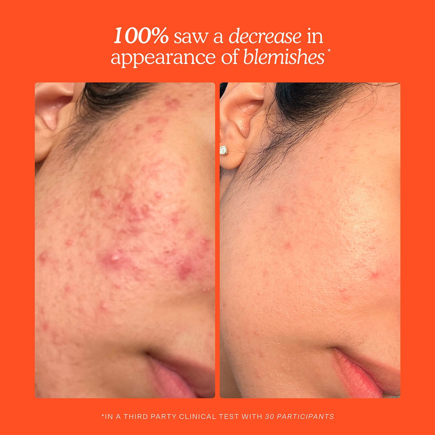 SOS Daily Hypochlorous Acid Spray for Breakouts & Redness-Tower 28