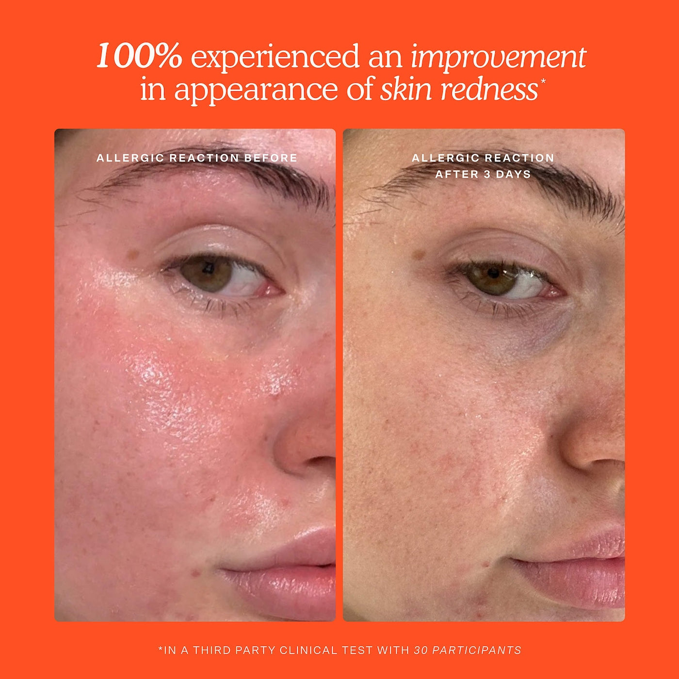 SOS Daily Hypochlorous Acid Spray for Breakouts & Redness-Tower 28
