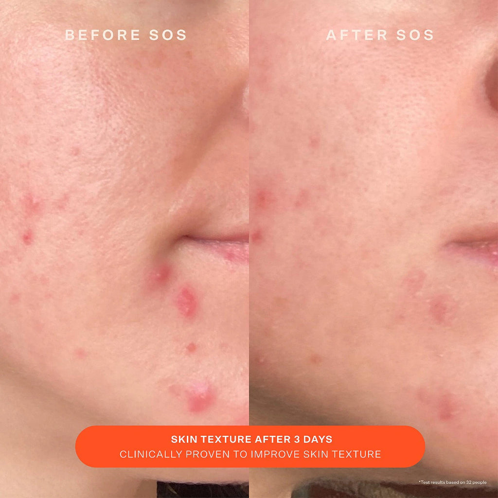 SOS Daily Skin Barrier Redness Recovery Moisturizer-Tower 28